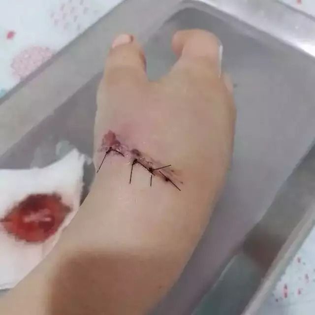 Mão da criança após retirar a bala. (Arquivo pessoal/Campo Grande News)