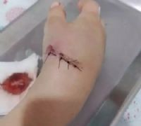 Mão da criança após retirar a bala. (Arquivo pessoal/Campo Grande News)