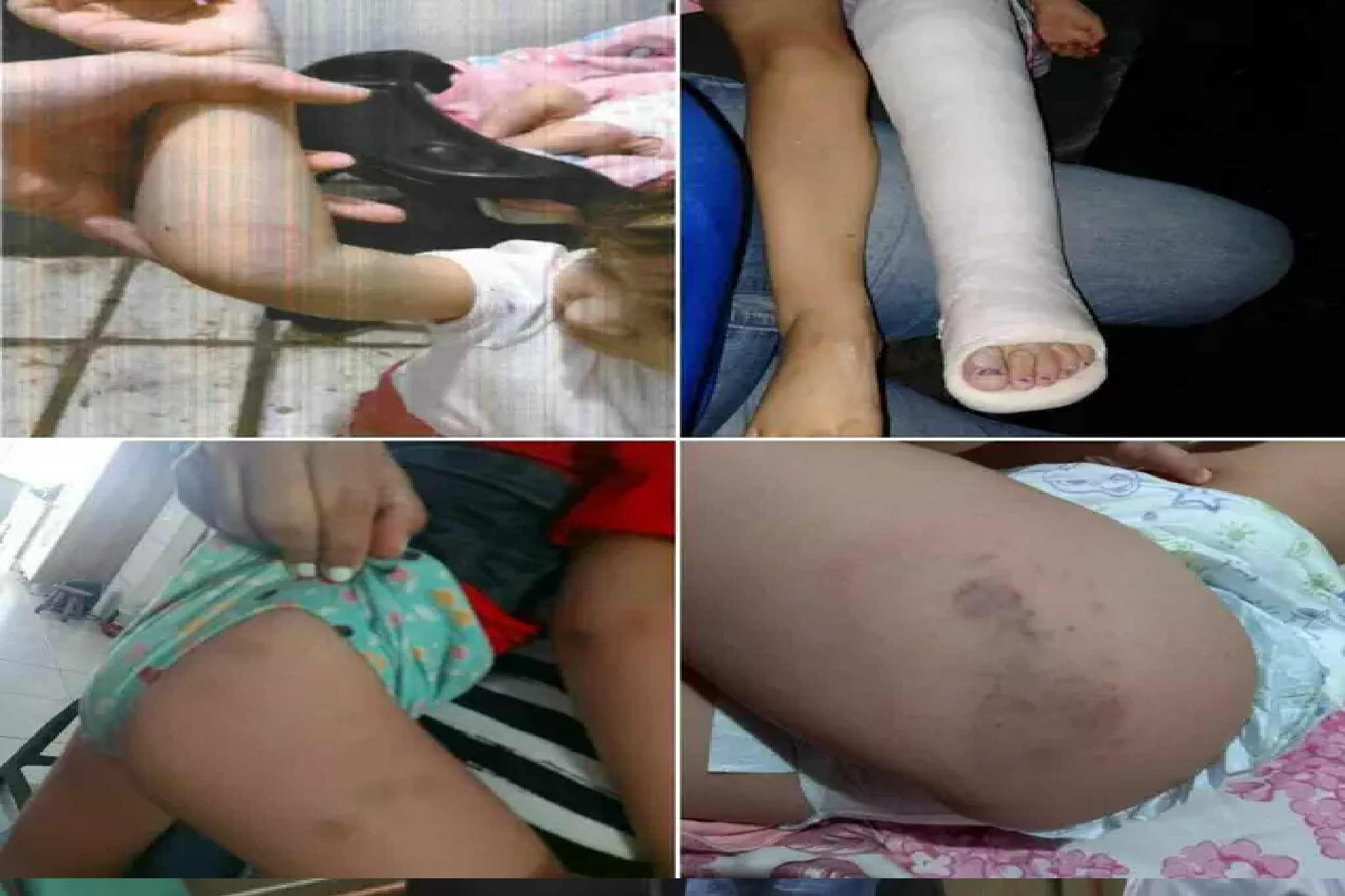 Marcas no corpo de Sophia em registros feitos pela mãe e pelo pai biológico; garotinha teve a perna quebrada com chute do padrasto, segundo a investigação. (Fotos: Reprodução processual)  